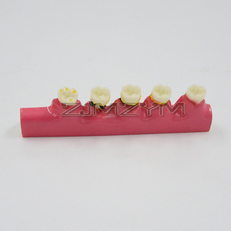 Periodontal Disease Model Dent - Medical Lab Study review and price