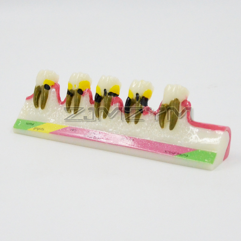 Periodontal Disease Model Dent - Medical Lab Study review and price